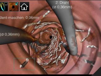 3D-Darstellung während eines Kathetereingriffs mit OCT-Unterstützung