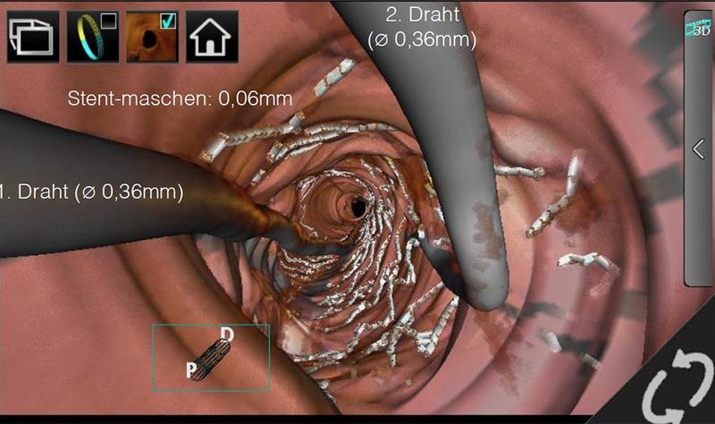 3D-Darstellung während eines Kathetereingriffs mit OCT-Unterstützung